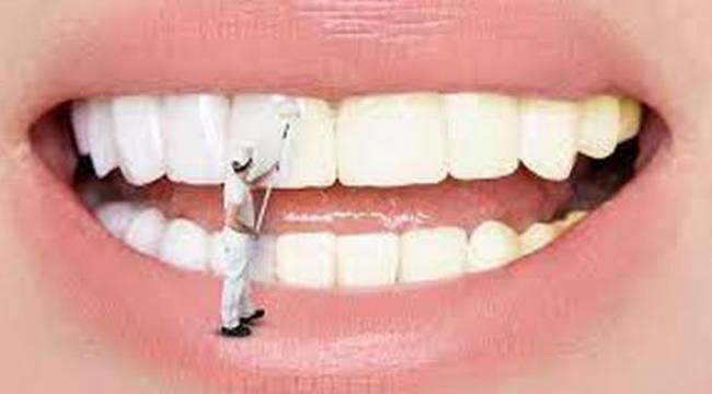 Diş Beyazlatma Tedavisi Nedir ?